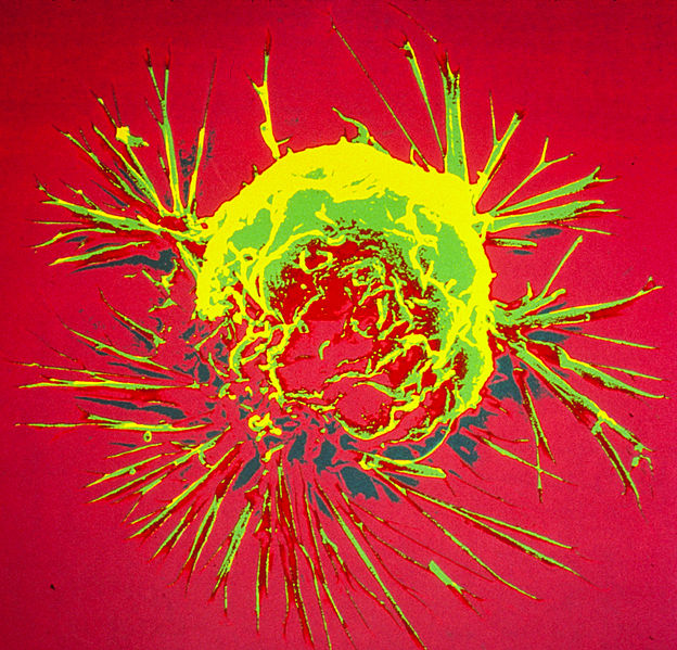 624px-breast_cancer_cell_1